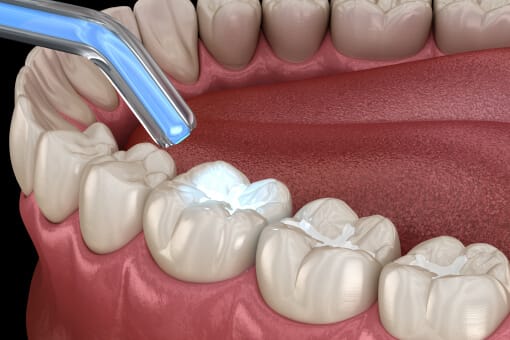 Dental Fillings