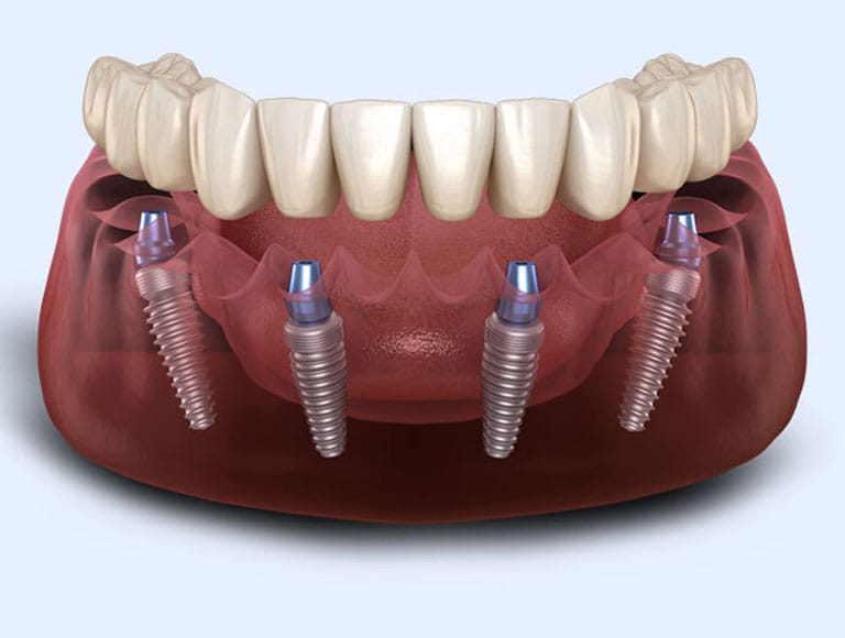 Dental Implants at Race Track Smiles in Tampa, FL