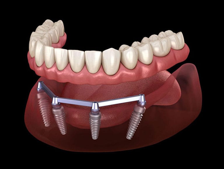 Why Choose All-On-4®?