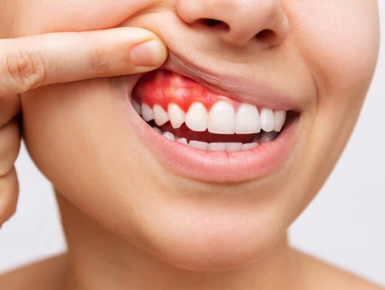 Are You Experiencing Signs of Gum Disease?